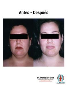 Liposucción de la papada - Foto Antes de - Dra. Marcela Yépez Intriago