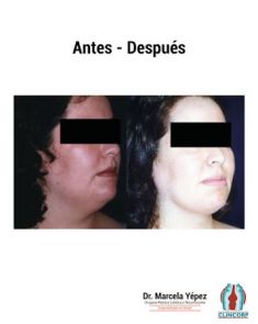 Liposucción de la papada - Foto Antes de - Dra. Marcela Yépez Intriago