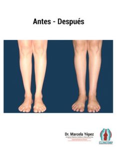 Lipotransferencia de grasa (lipofiling) - Foto Antes de - Dra. Marcela Yépez Intriago