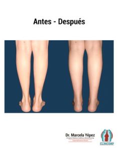 Lipotransferencia de grasa (lipofiling) - Foto Antes de - Dra. Marcela Yépez Intriago