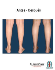 Lipotransferencia de grasa (lipofiling) - Foto Antes de - Dra. Marcela Yépez Intriago