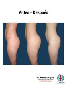 Lipotransferencia de grasa (lipofiling) - Foto Antes de - Dra. Marcela Yépez Intriago