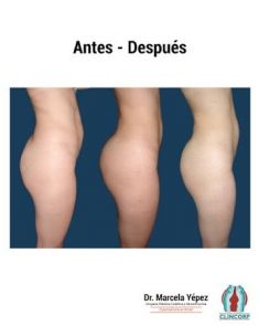 Lipotransferencia de grasa (lipofiling) - Foto Antes de - Dra. Marcela Yépez Intriago