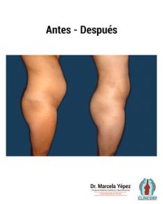 Lipotransferencia de grasa (lipofiling) - Foto Antes de - Dra. Marcela Yépez Intriago