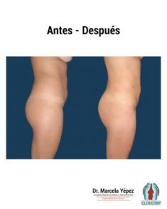 Lipotransferencia de grasa (lipofiling) - Foto Antes de - Dra. Marcela Yépez Intriago
