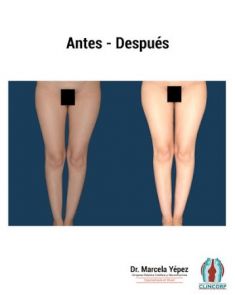 Lipotransferencia de grasa (lipofiling) - Foto Antes de - Dra. Marcela Yépez Intriago