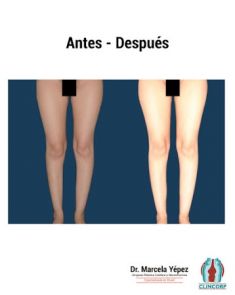 Lipotransferencia de grasa (lipofiling) - Foto Antes de - Dra. Marcela Yépez Intriago
