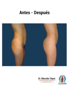 Lipotransferencia de grasa (lipofiling) - Foto Antes de - Dra. Marcela Yépez Intriago