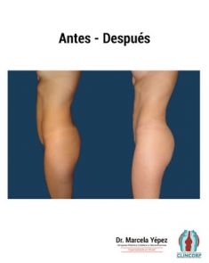 Lipotransferencia de grasa (lipofiling) - Foto Antes de - Dra. Marcela Yépez Intriago