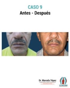 Lipotransferencia de grasa (lipofiling) - Foto Antes de - Dra. Marcela Yépez Intriago
