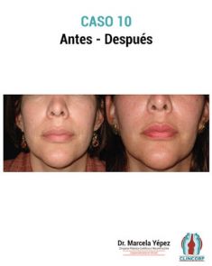 Lipotransferencia de grasa (lipofiling) - Foto Antes de - Dra. Marcela Yépez Intriago