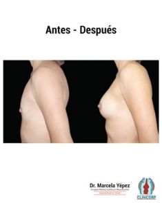 Aumento de senos o mamoplastia de aumento (implantes mamarios) - Foto Antes de - Dra. Marcela Yépez Intriago