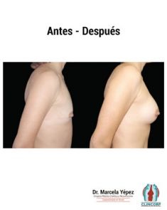 Aumento de senos o mamoplastia de aumento (implantes mamarios) - Foto Antes de - Dra. Marcela Yépez Intriago