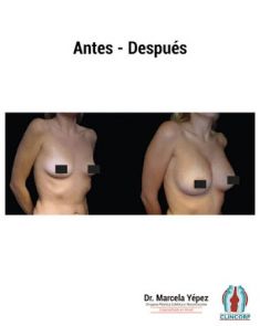 Aumento de senos o mamoplastia de aumento (implantes mamarios) - Foto Antes de - Dra. Marcela Yépez Intriago