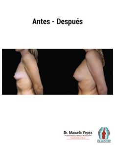 Aumento de senos o mamoplastia de aumento (implantes mamarios) - Foto Antes de - Dra. Marcela Yépez Intriago