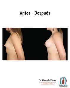 Aumento de senos o mamoplastia de aumento (implantes mamarios) - Foto Antes de - Dra. Marcela Yépez Intriago