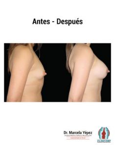 Aumento de senos o mamoplastia de aumento (implantes mamarios) - Foto Antes de - Dra. Marcela Yépez Intriago