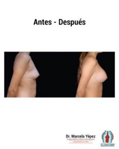 Aumento de senos o mamoplastia de aumento (implantes mamarios) - Foto Antes de - Dra. Marcela Yépez Intriago