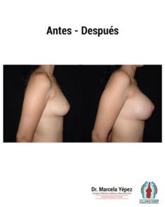 Aumento de senos o mamoplastia de aumento (implantes mamarios) - Foto Antes de - Dra. Marcela Yépez Intriago
