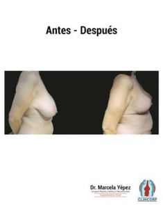 Reducción de mamas - Foto Antes de - Dra. Marcela Yépez Intriago