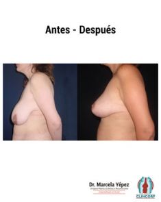Reducción de mamas - Foto Antes de - Dra. Marcela Yépez Intriago