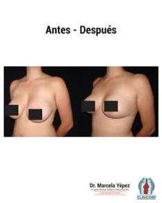Reducción de mamas - Foto Antes de - Dra. Marcela Yépez Intriago