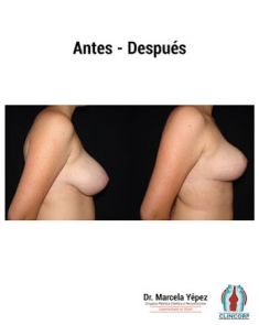 Reducción de mamas - Foto Antes de - Dra. Marcela Yépez Intriago