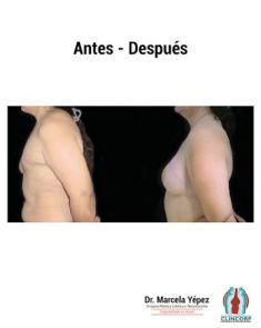 Reconstrucción mamaria - Foto Antes de - Dra. Marcela Yépez Intriago