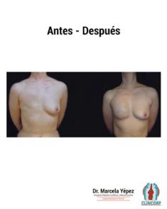 Reconstrucción mamaria - Foto Antes de - Dra. Marcela Yépez Intriago