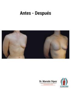 Reconstrucción mamaria - Foto Antes de - Dra. Marcela Yépez Intriago