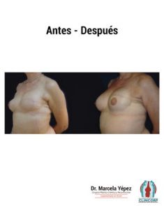 Reconstrucción mamaria - Foto Antes de - Dra. Marcela Yépez Intriago