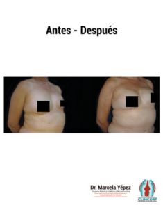 Reconstrucción mamaria - Foto Antes de - Dra. Marcela Yépez Intriago