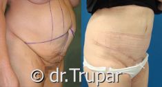 Abdominoplastika (Operace břicha) - fotka před - MUDr. Evžen Trupar Ph.D.