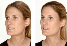 Hyaluronic acid-based wrinkle fillers - Photo before - Dr. Dobos Calin
