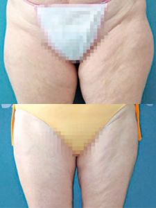 Liposukcia tumescenčná - Fotka pred - ENVY klinika estetickej medicíny