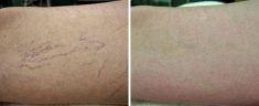 Laserowe usuwanie rozszerzonych naczynek - Zdjęcie przed - Revival Clinic - Klinika Medycyny Estetycznej i Laseroterapii