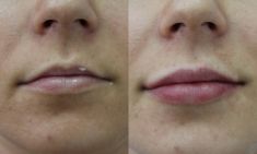 Lip augmentation - cheiloplasty - Photo before - ARS ESTETICA – Klinika Medycyny Estetycznej i Laseroterapii