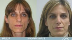 Rinoplastica - Foto del prima - Dott. Maurizio Baldo M.D.