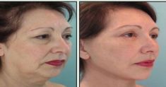Revitalización de la cara - Foto Antes de - Dra. Grissel Mayen