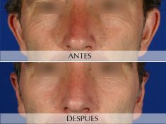 Otoplastia - Foto Antes de - Clínica Planas