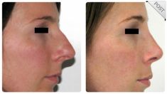 Cirugía de la nariz (Rinoplastia) - Foto Antes de - Dr. Fernando Martín Monsalve