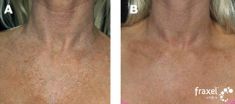 Fractional Laser Resurfacing - Photo before - Bieńkowscy Clinic®