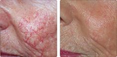 Spider veins laser removal (redness, birh marks) - Photo before - Bieńkowscy Clinic®