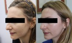 Scar removal - Photo before - ARS ESTETICA – Klinika Medycyny Estetycznej i Laseroterapii