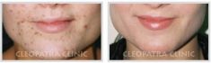 Laser procedures in aesthetic dermatology - Photo before - Cleopatra Clinic, Klinika Plastické Chirurgie s.r.o.