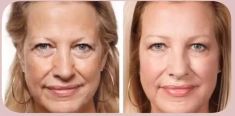 Botox/Dysport - Eliminar arrugas - Foto Antes de - Dra. Grissel Mayen