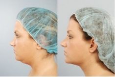 Liposuzione laser - Smart Lipo - Foto del prima - Dr. Luigi Mazzi
