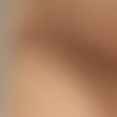 Fractional Laser Resurfacing - Photo before - ARS ESTETICA – Klinika Medycyny Estetycznej i Laseroterapii