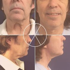 Neck lift - Photo before - MUDr. Lucie Kalinová PhD.