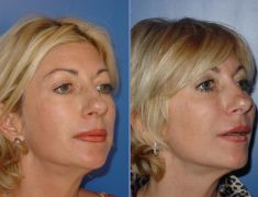 Dermal fillers - Photo before - prim. MUDr. Miroslava Pelechová